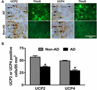 Glia Maturation Factor and Mitochondrial Uncoupling Proteins 2 and 4 Expression in the Temporal Cortex of Alzheimer’s Disease Brain